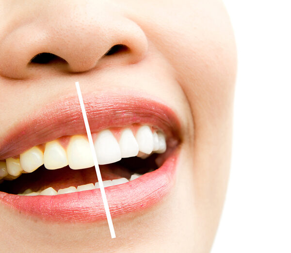 edremitte-dis-beyazlatma-neden-gerekli